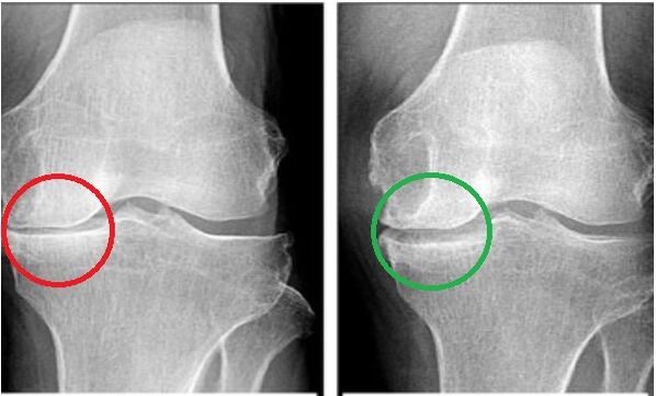 Depanten returned mobility to my joints