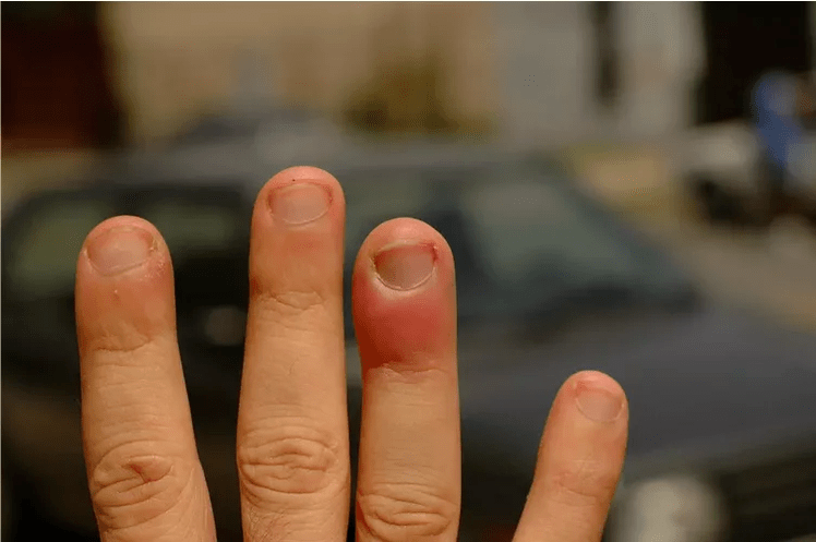 Periungual whitlow, causing pain in the finger joints