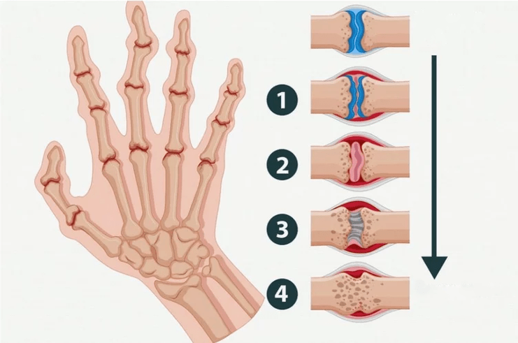 Stages of rheumatoid arthritis that affect the finger joints