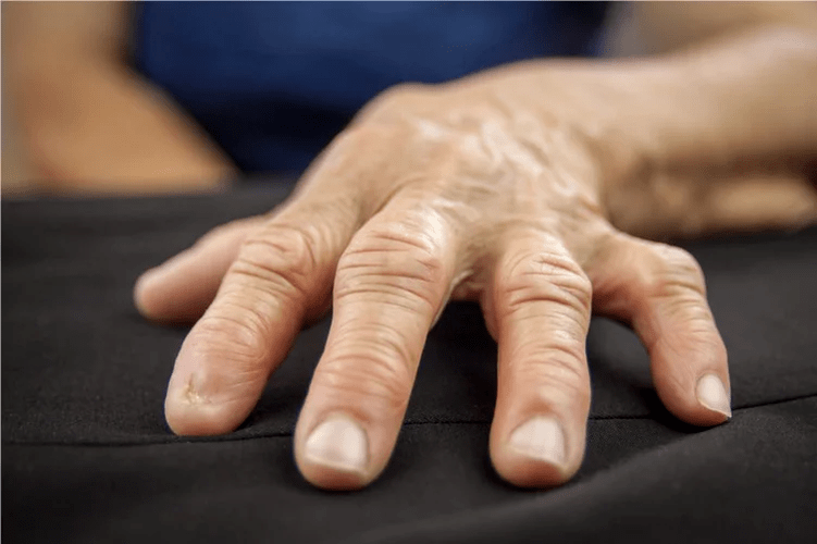 With gout, the knuckles feel hot to the touch, swollen and painful. 