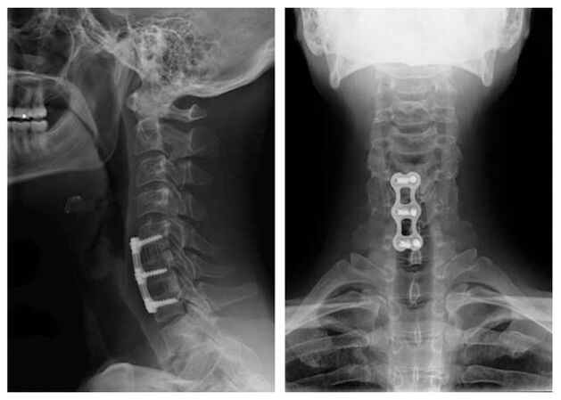 image after vertebrae treatment