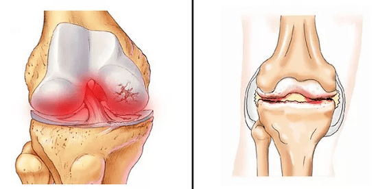 Arthritis arthrosis comparison