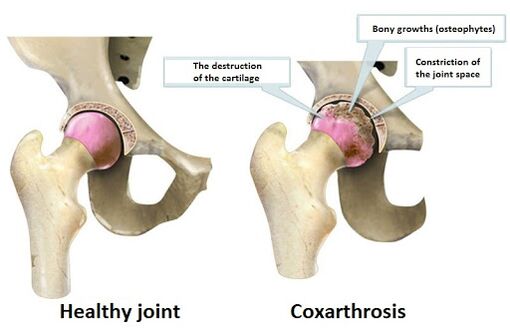 Healthy articulation affected by the articulation of cOKSARTROSIS