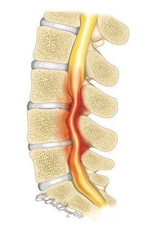 With osteochondrosis of the thoracic spine, compression of the spinal canal occurs