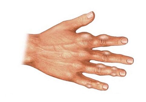 Deposition of uric acid crystals in soft tissues in gout