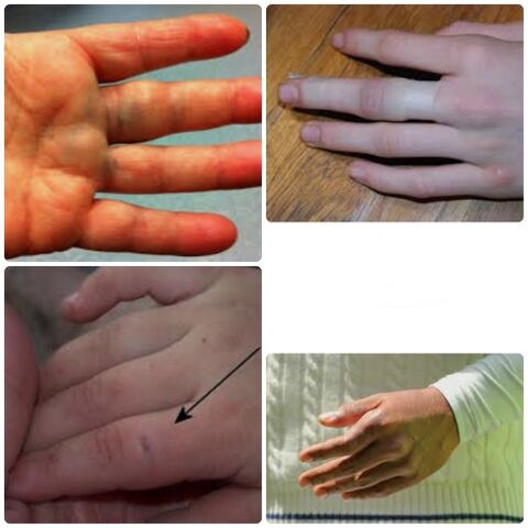 Finger bruises and fractures are characterized by pain and swelling in the joints.
