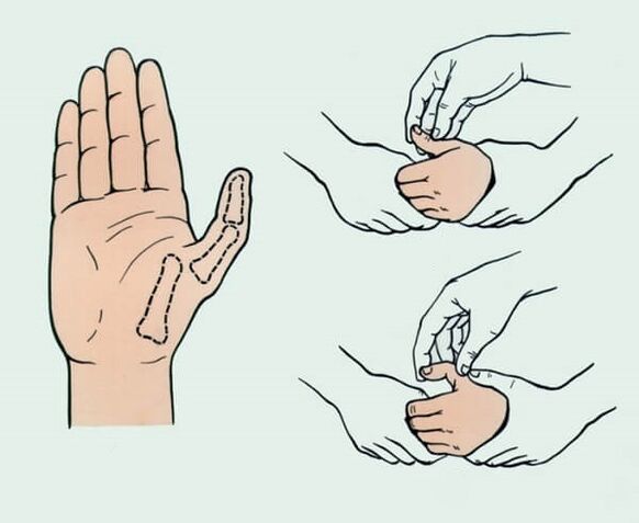 Reduction of a dislocated finger, necessary to eliminate joint pain