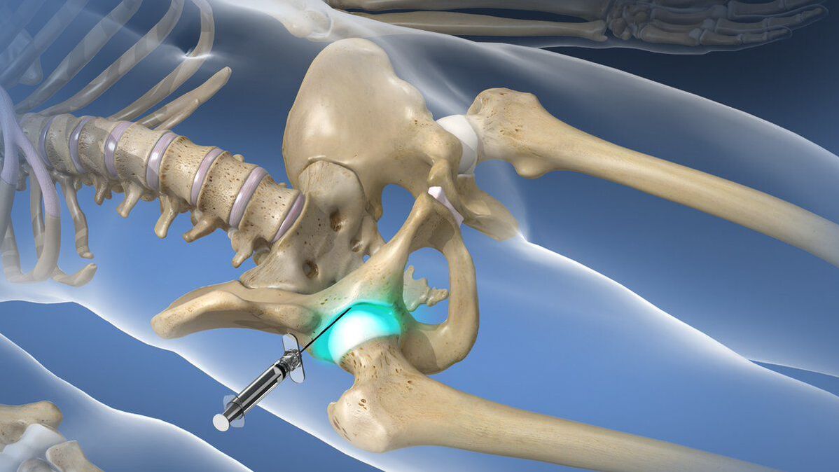 Intra-articular block for severe pain accompanying hip osteoarthritis