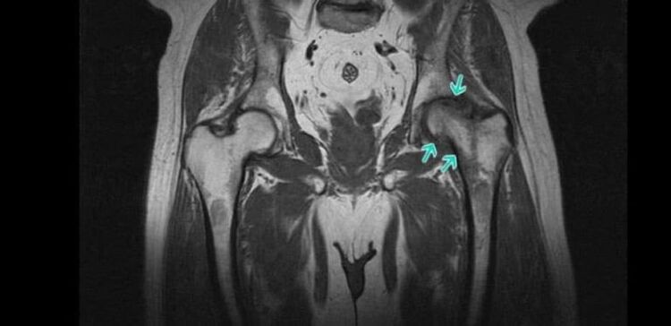 Osteoarthritis of the hip joint on MRI