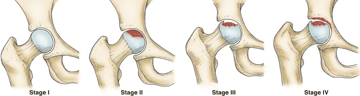 Osteoarthritis of the hip joint