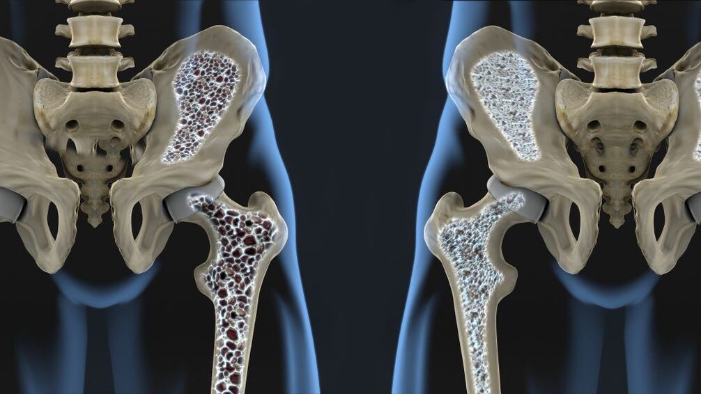 Osteoporosis is the cause of hip fracture and hip arthrosis