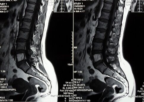 Lumbosacral spine MRI to diagnose low back pain