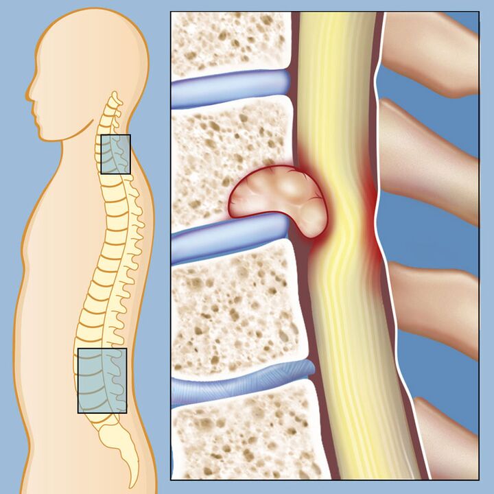 Malignant tumor as a cause of severe low back pain